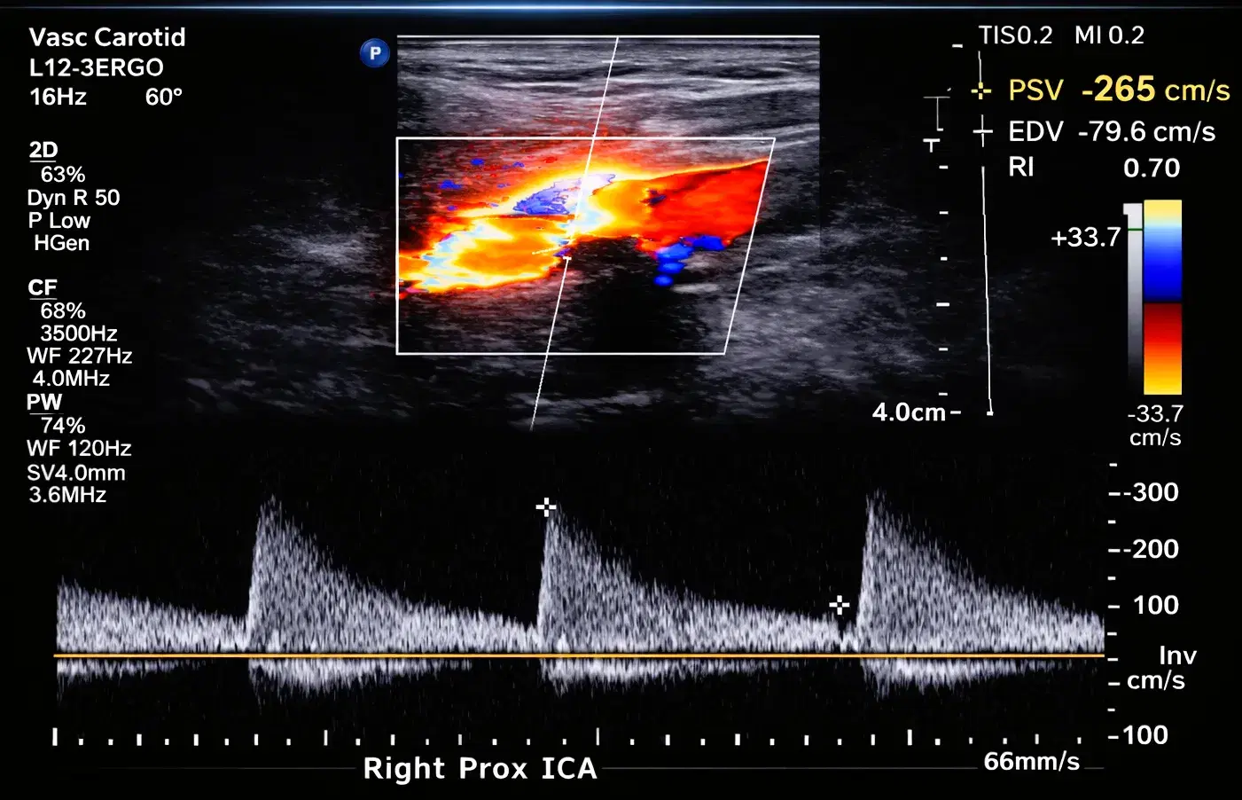 Non-Invasive Cerebrovascular Interpretation (Extracranial)